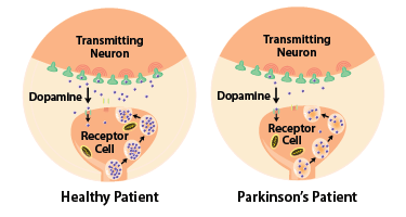 Parkinson’s Disease